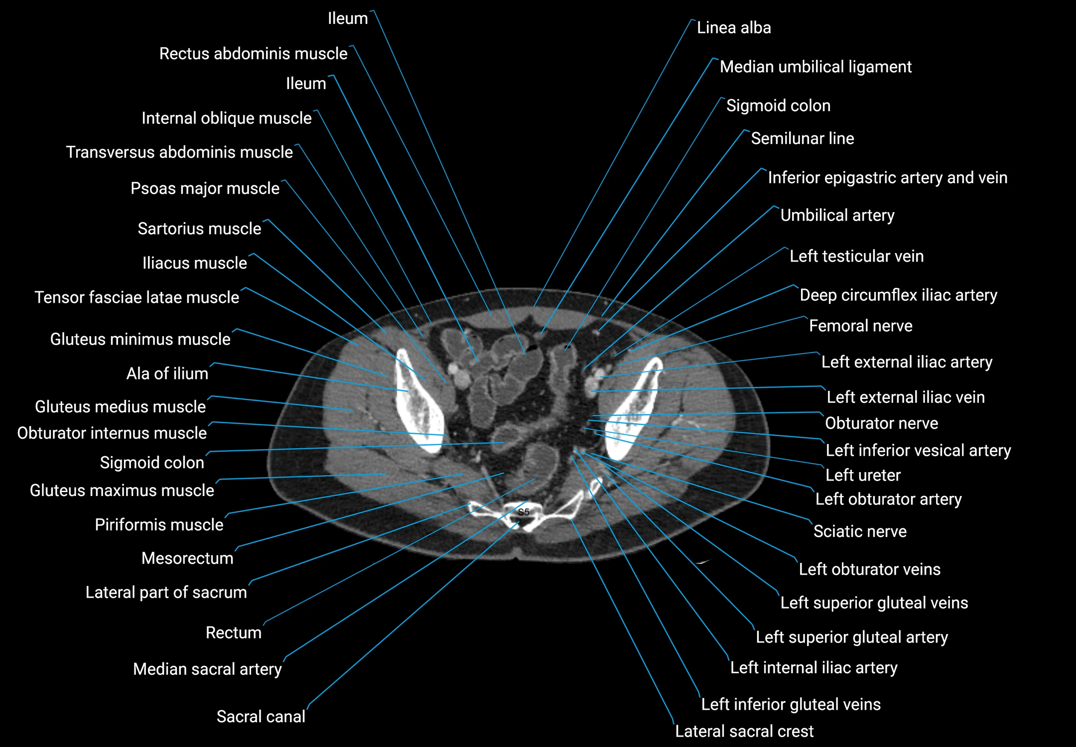 CT male pelvis axial cross sectional anatomy labelled radiology image -00168.webp